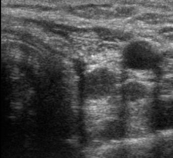 Intraoperative Ultrasound localization Case 2: