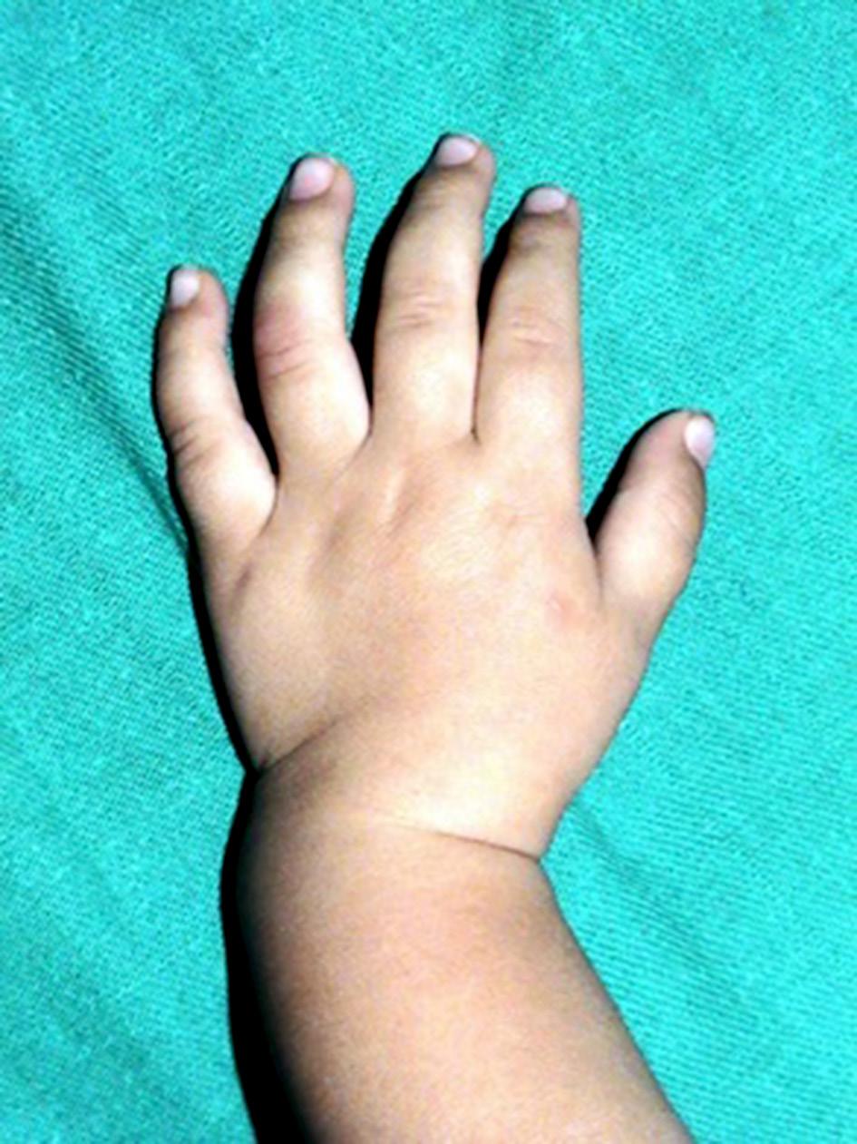 In all cases, the deformity started during the first year of life and worsened afterward. Wrist and upper extremity radiographs revealed that the radius was shorter than ulnar bone.