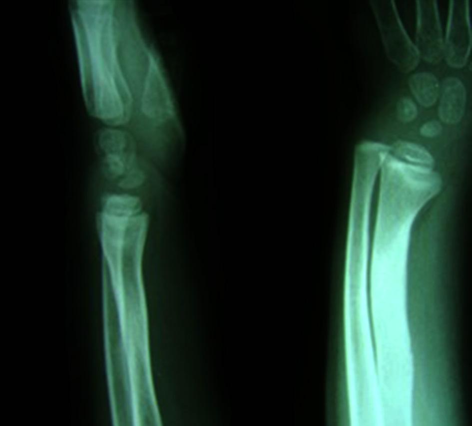 We applied long arm splint for six weeks. Clinical appearance and plain radiography after 24