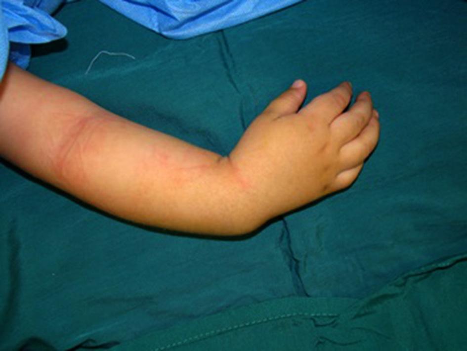 Case 2 A 3-year-old boy presented to the hand clinic due to the right wrist deformity since two years ago.
