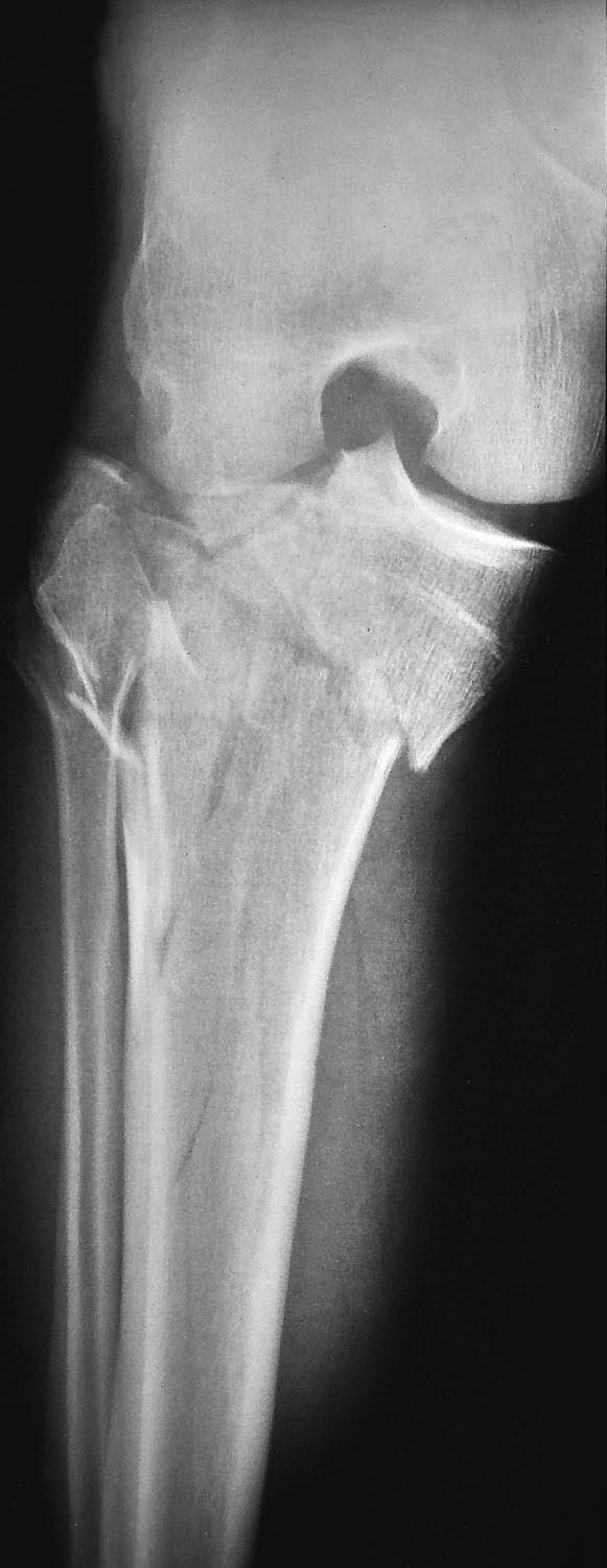 8-A An AO type-c3 tibial plateau fracture with a large medial fragment and severe lateral displacement and depression. Fig.