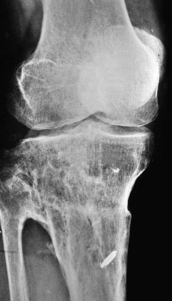 8-F) radiographs showing that the lateral condyle does not fall
