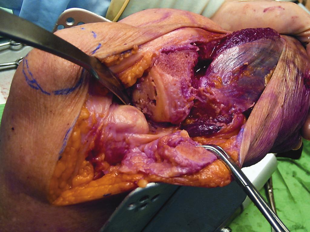 107 Figs. 4-D and 4-E After dissection of the peroneal nerve and the osteotomy of the Gerdy tubercle as well as the fibular head, a full exposure of the lateral tibial plateau can be achieved.