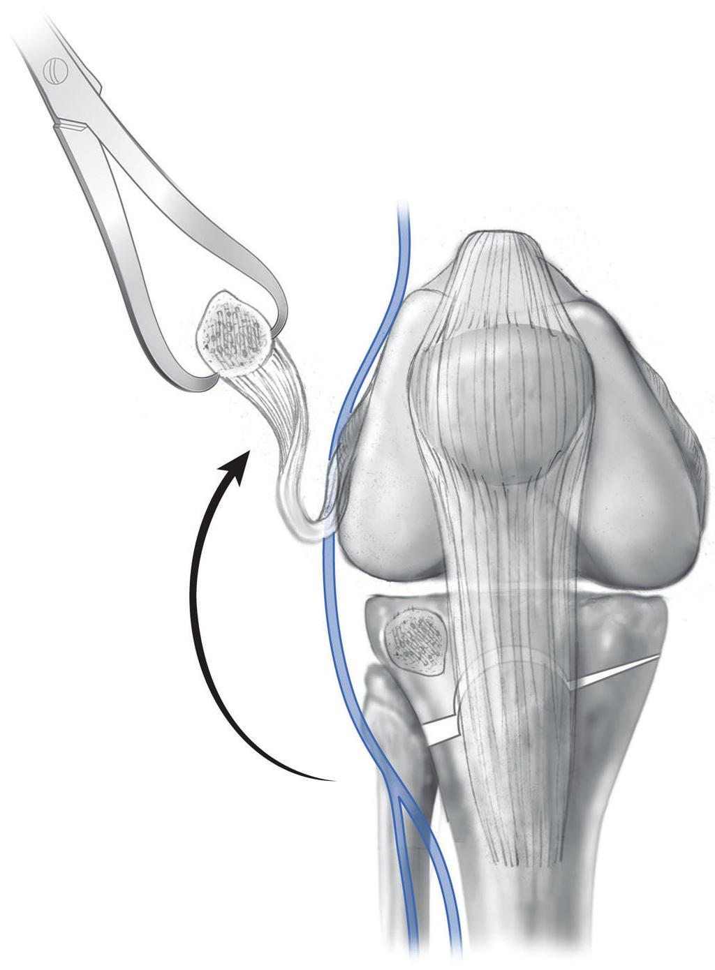 with a 3.5-mm lag screw. FIG. 4-D FIG. 4-E the joint incongruency. With a standard lateral arthrotomy, the anterior 50% to 60% of the lateral plateau can easily be visualized and approached (Fig.