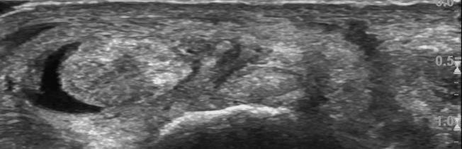 Flexor Tendon Pathology: Tendinosis with Interstitial Tear A P SAX Image provided by Dr.