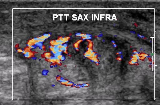 Flexor Tendon Pathology: Tendinosis with Interstitial Tear Companion case Video provided by Dr.