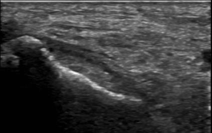 Flexor Tendon Pathology: Full Thickness Tear A P SAX Tendinosis, characterized by hypo-echogenicity and