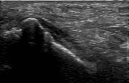 Flexor Tendon Pathology: Full Thickness Tear A P SAX Tendinosis, characterized by hypo-echogenicity and heterogeneity of the fiber architecture Attenuation