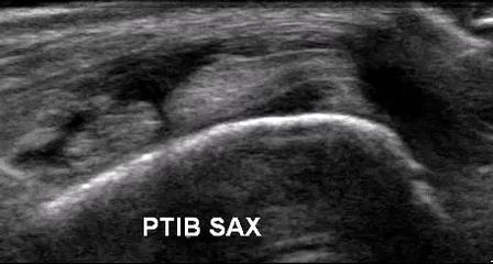 Flexor Tendon Pathology: PT Tendon Instability/Subluxation Video provided by Dr.