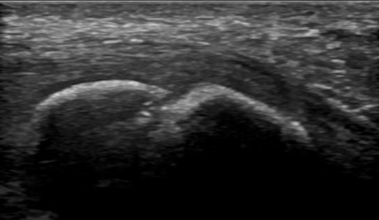 Accessory Navicular Bone Pathology: Symptomatic Os Naviculare P Os Nav D LAX Intact PT tendon Image provided by Dr.