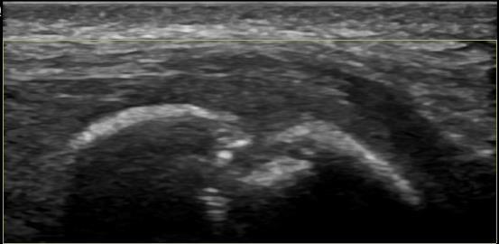 Accessory Navicular Bone Pathology: Symptomatic Os Naviculare P D Os Nav LAX Intact PT tendon Image provided by Dr.