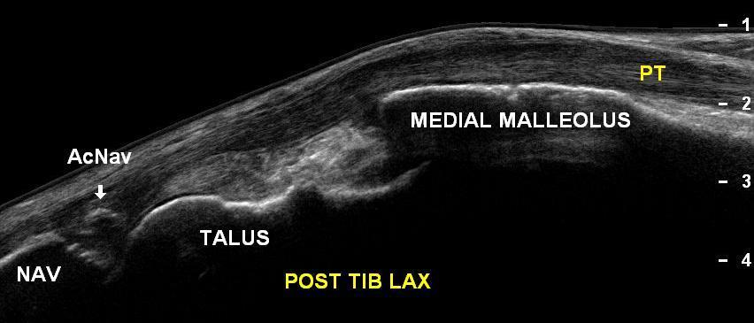 Flexor Tendon Anatomy Posterior Tibialis Image provided by Dr.