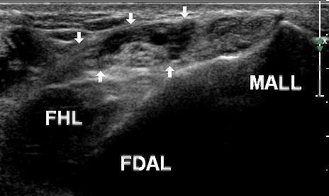 Tarsal Tunnel Syndrome: FDAL Image provided by Dr.
