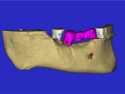 FIGURE 4 Creating a fully interactive three dimensional reconstruction allows the clinician further insight into the patient's existing anatomical presentation.