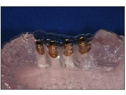 A novel modality pioneered by the author utilizes a CT-derived stereolithographic model-based approach to link the implant placement and the eventual restoration.
