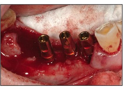 The implants were well fixated allowing for immediate restoration [FIGURE 11].