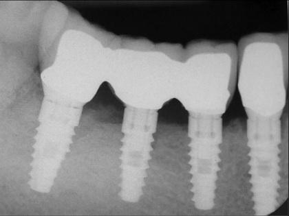 When the fourth implant had integrated after 8 weeks in function, impressions were made and a soft tissue working cast fabricated for the laboratory process.