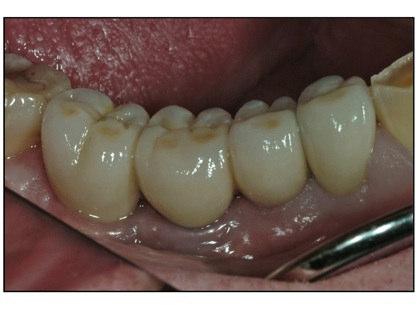FIGURE 16 The final glaze and porcelain characteristics of the posterior four units blend in nicely with the surrounding dentition and soft tissue [FIGURE 16].
