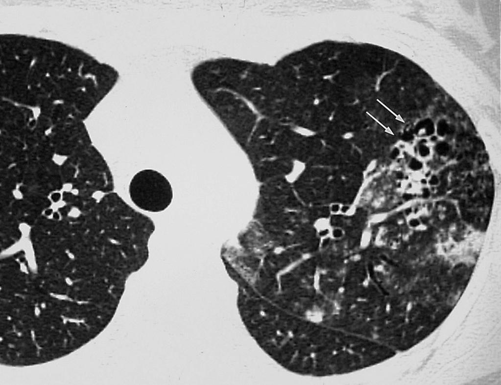fter steroid pulse therapy for 2 weeks, most lung lesions resolved (not shown). Fig. 2. cute lupus pneumonitis in a 21-year-old woman with SLE.