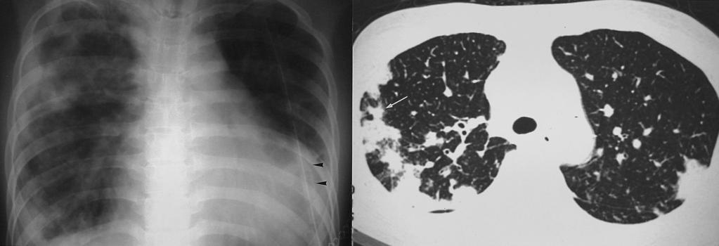 With the cessation of hemoptysis, the findings of radiography improve rapidly and often normalize within 2-4 days (2). CT demonstrates ground-glass opacity and, sometimes, frank consolidation.
