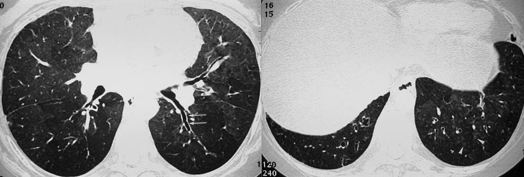 Kee Hyuk Yang, et al : Pulmonary Manifestations of Systemic Lupus Erythematosus tissue diseases including SLE. The prognosis is generally excellent.