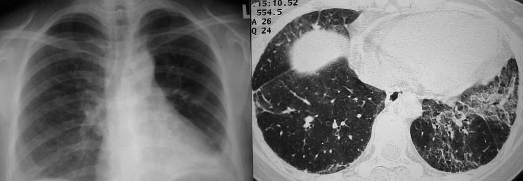 Mild enlargement of the mediastinal lymph nodes is common. Pulmonary vascular disease Pulmonary vascular involvement in SLE may include the capillary, arterial, and venous systems.