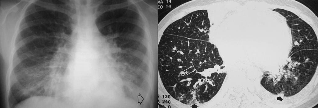 Pulmonary veno-occlusive disease Pulmonary veno-occlusive disease is a rare form of pulmonary hypertension characterized pathologically by repeated pulmonary venous thrombosis, and clinically by