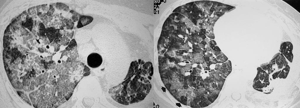 J Korean Radiol Soc 2004;50:37-45 and pulmonary veins of normal caliber (Fig. 9). mosaic pattern of lung attenuation, as well as pleural effusion, is frequently present.