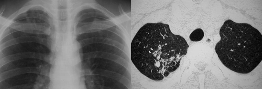 Kee Hyuk Yang, et al : Pulmonary Manifestations of Systemic Lupus Erythematosus Pulmonary Tuberculosis in SLE Pulmonary tuberculosis in patients with SLE may manifest differently than in