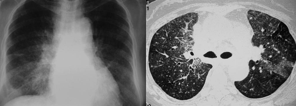 Delayed diagnosis may contribute to a higher incidence of miliary, far-advanced, and extrapulmonary tuberculosis.