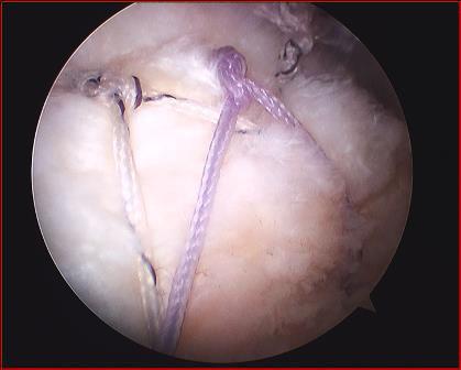 Rotator cuff tear Surgically Repaired Rotator Cuff Subacromial Decompression A subacromial decompression involves removal of inflamed tissue within the space above the shoulder joint between the