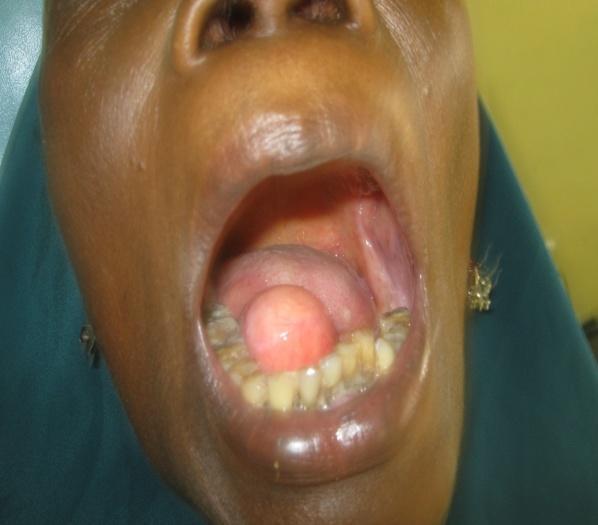 most prevalent, followed by the buccal mucosa, lip, submandibular region, tougue, palate, floor of the mouth and the buccal vestibule.