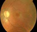 The pale optic disc Congenital or myopia Secondary to raised ICP Ildefined borders vascular retinal disease