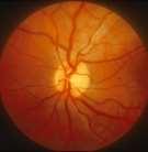 Examination Structure ( optic disc) Function Examination of the optic disc The only cranial nerve (brain tract) which could be directly seen