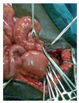inflamed retrocecal appendix bound down by fibrous