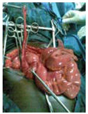 Figure 2 shows the left-sided appendix after