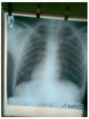Also a plain chest radiograph and an ECG, done post-operatively, confirmed dextrocardia (figure 4).