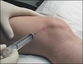 Knee Intra articular Joint Injection 5 cc syringe, 21 gauge 1.