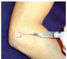 Tennis Elbow Injection 3 cc syringe, 25 gauge 1 inch needle 1% lidocaine - 1cc 10-20 mg triamcinolone -.25 to.