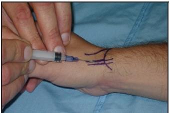 de Quervain's Tenosynovitis Injection 3 cc syringe, 25 gauge 1 inch needle 1% lidocaine - 2cc 10mg triamcinolone -.