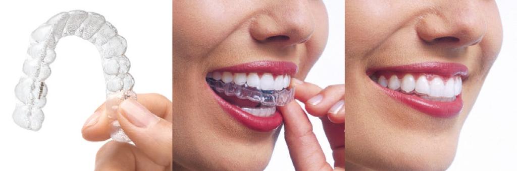 4. COMFORTABLE Invisalign aligners are comfortable to wear. There are no metal wires or brackets that could potentially irritate your mouth or gums. 5.