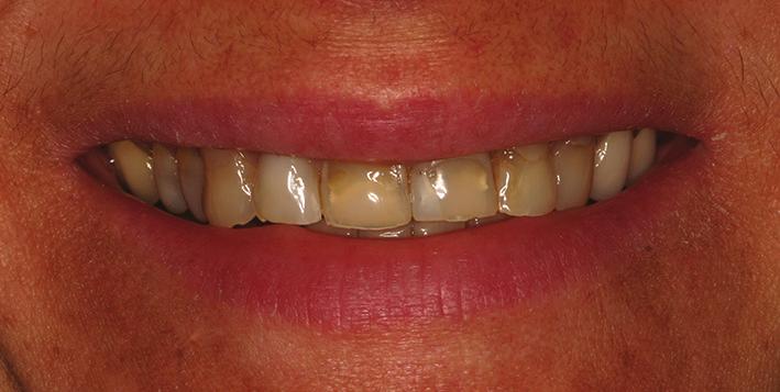 2 Case Reports in Dentistry Figure 1: Clinical view of the smile. Figure 3: Flap incision. Figure 2: Intraoral clinical aspect. Figure 4: Flap is elevated according to a mixed thickness.