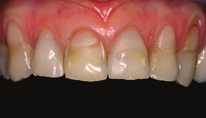 Complete scaling and root planning were performed and oral hygiene instructions were given 4 weeks prior to surgery.