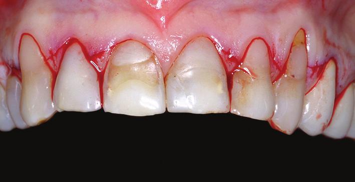 In order to evaluate the better surgical technique suited to the situation, we considered the local anatomical conditions relating to teeth and soft tissues.