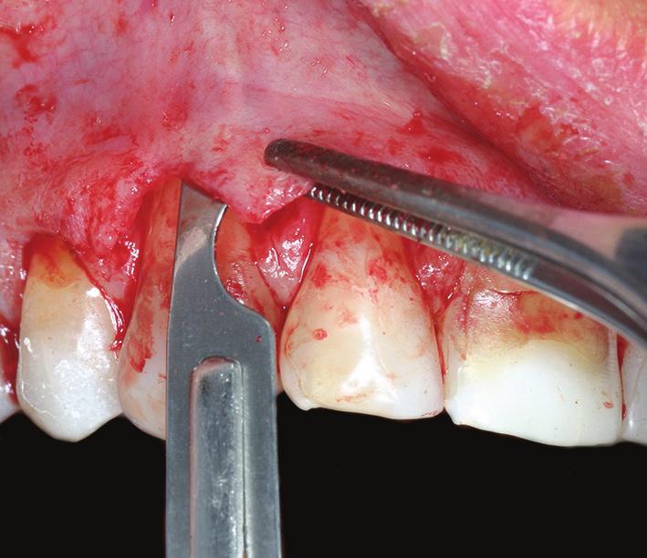Case Reports in Dentistry 3 Figure 10: Soft tissue health two weeks after surgery.