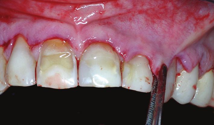 Figure 12: Dental preparation 9 months after periodontal plastic surgery.