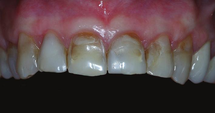 obtained, the clinician has faced the second clinical question regarding the type of dental