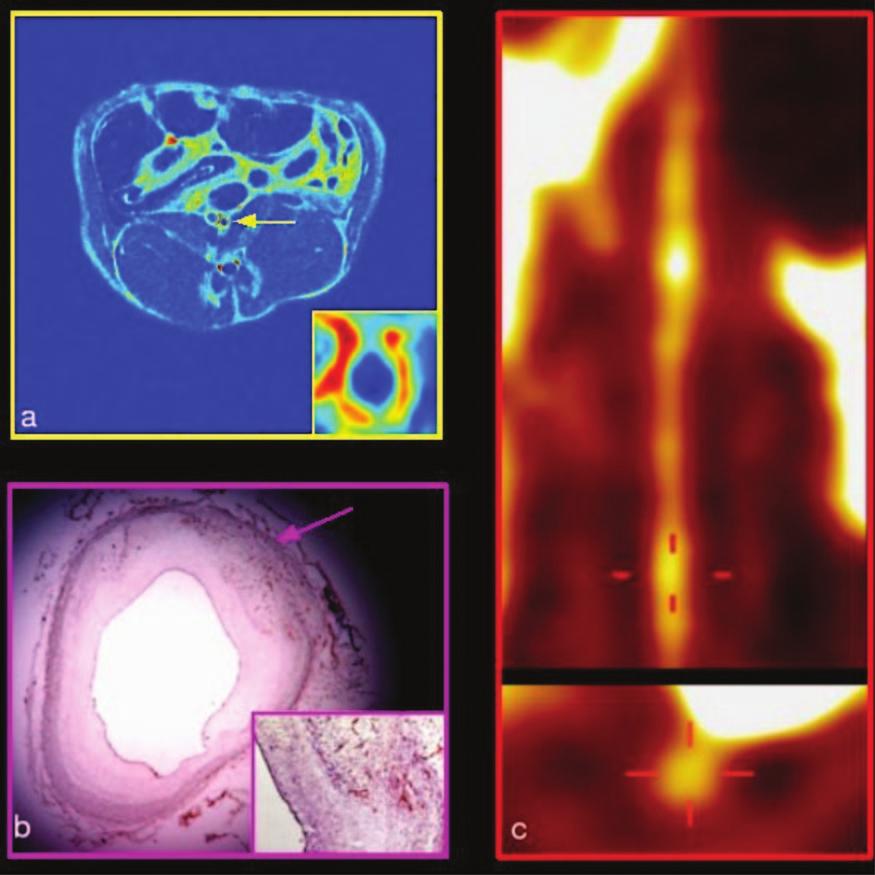 Calcagno et al Detection of Neovessels in Atherosclerosis by MRI and PET 1315 Figure 4. a, Representative color-coded AUC map by DCE-MRI.