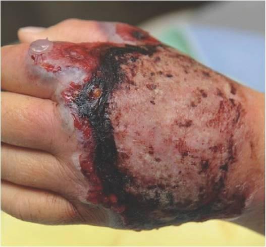 Figures Figure 1: Non-healing wound on dorsum of left hand Figure 2: Improvement in pyoderma gangrenosum following three days of intravenous steroids (A), one week of oral steroids (B),