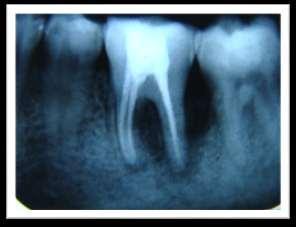 Root canal treatment was carried out with a crown down technique according to standard protocol.
